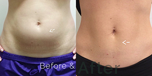 Tummy Fat Removal Treatment