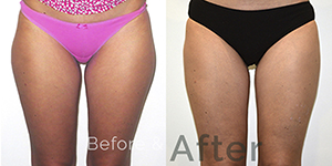 Tummy Fat Removal Treatment