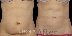 Tummy Fat Removal Treatment