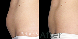 Tummy Fat Removal Treatment