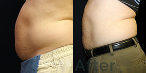 Tummy Fat Removal Treatment